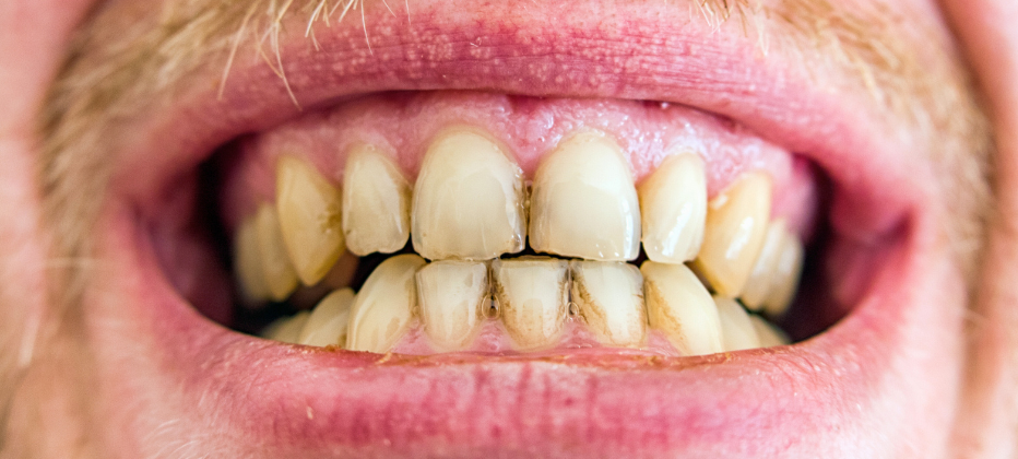 Tratamiento para el desgaste dental en Valencia