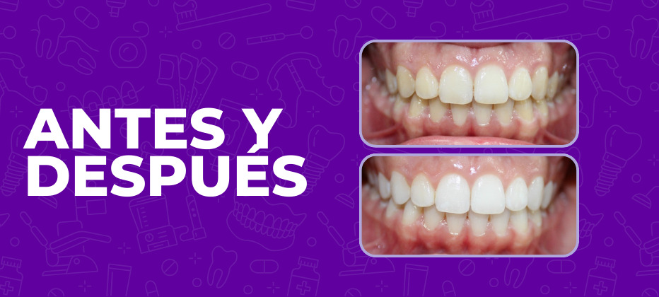 casos clinicos reales de blanqueamiento dental en valencia