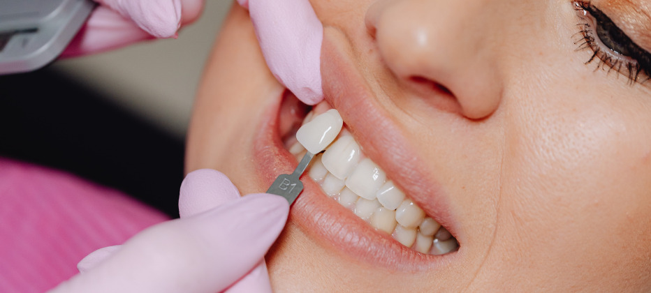 como es el tratamiento de carillas de porcelana en valencia como es el tratamiento de carillas de porcelana en valencia