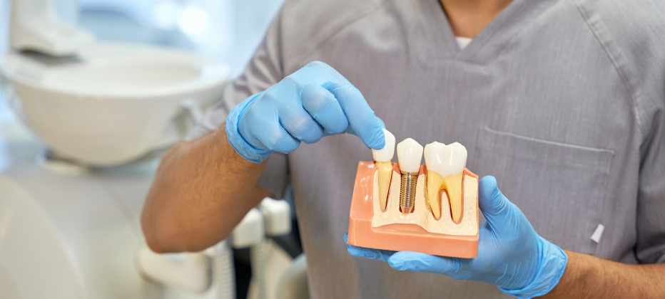 Implantes All on Four en Valencia